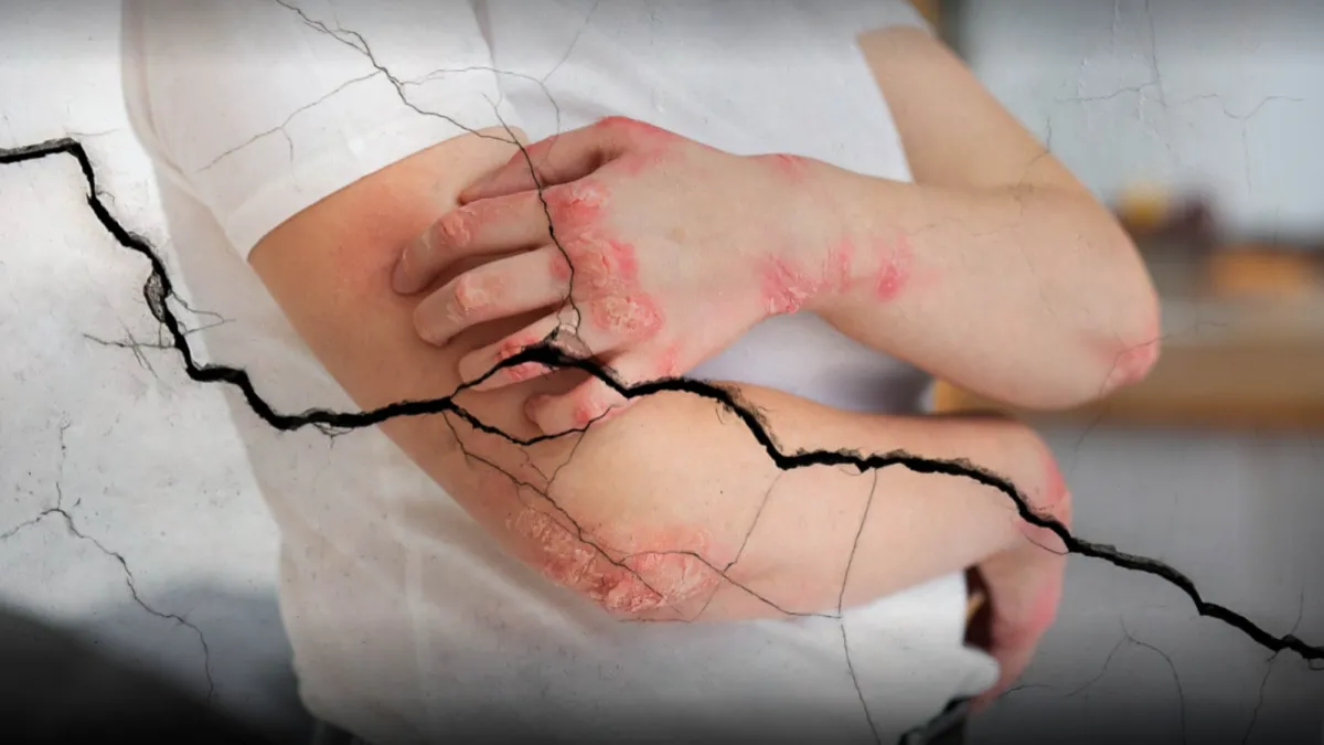 síntomas y signos de la lepra